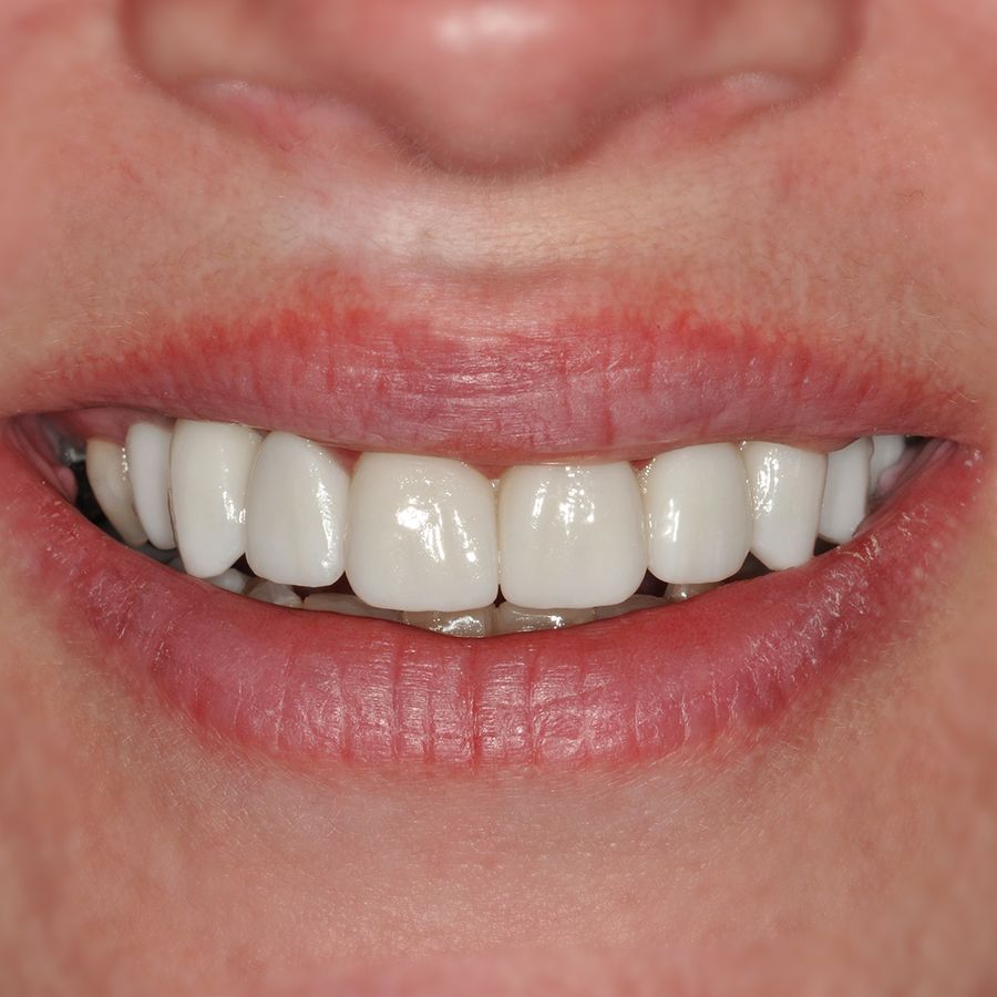 Implants, crowns, bridges - Lindsey Feeney - after - 3dental